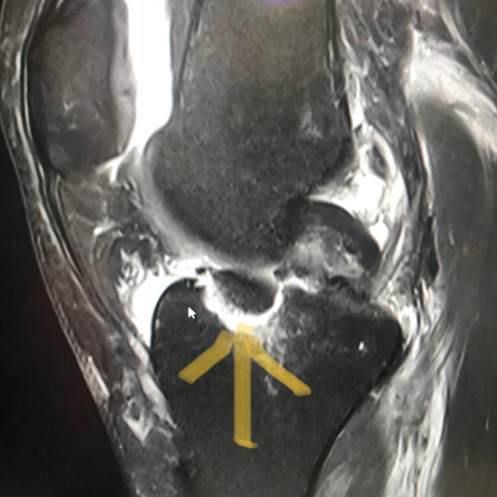 van vleuten rodilla